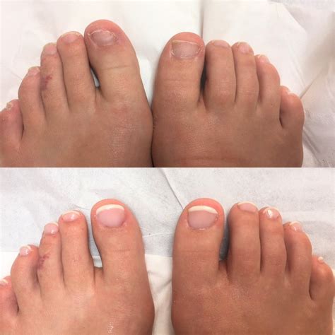 com Call us (719) 930-3602 Services Performed Cutting the toe nails Removal of minor calluses Essential oils applied Set aside 30-45 minutes for service. . Toenail reconstruction near me